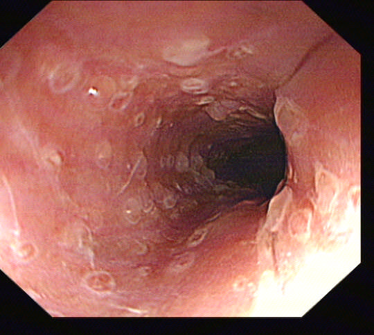 病毒性食管炎1例-老苏