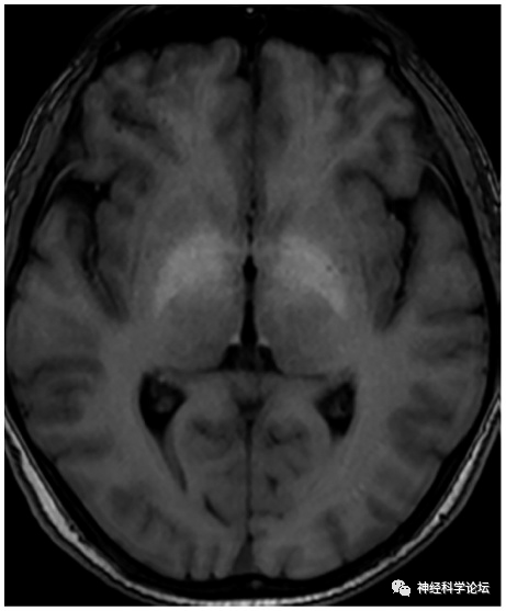 肝性脊髓病（hepaticmyelopathy，HM）-老苏