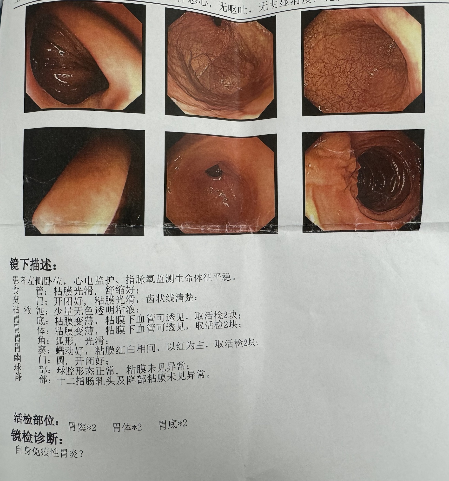 自身免疫性化生性萎缩性胃炎-老苏